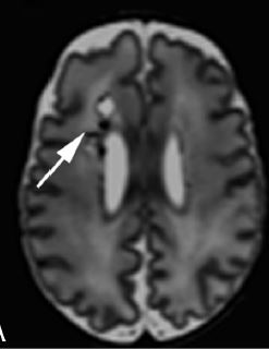 Focal Unilateral