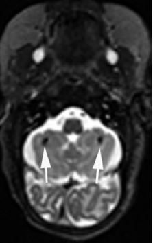 Punctate Bilateral