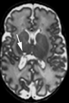 Focal Unilateral